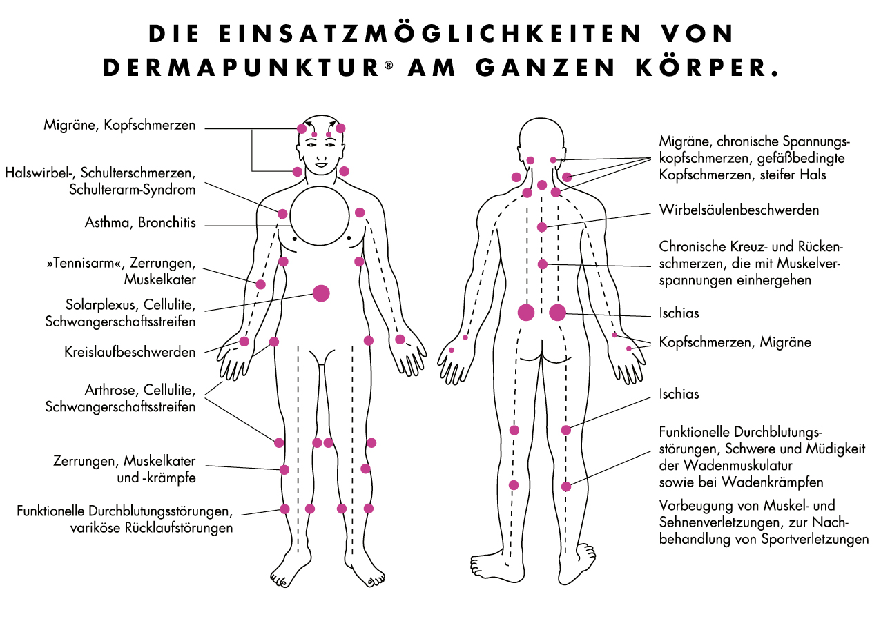 DERMAPUNKTUR Einsatzmöglichkeiten | RUSSKA